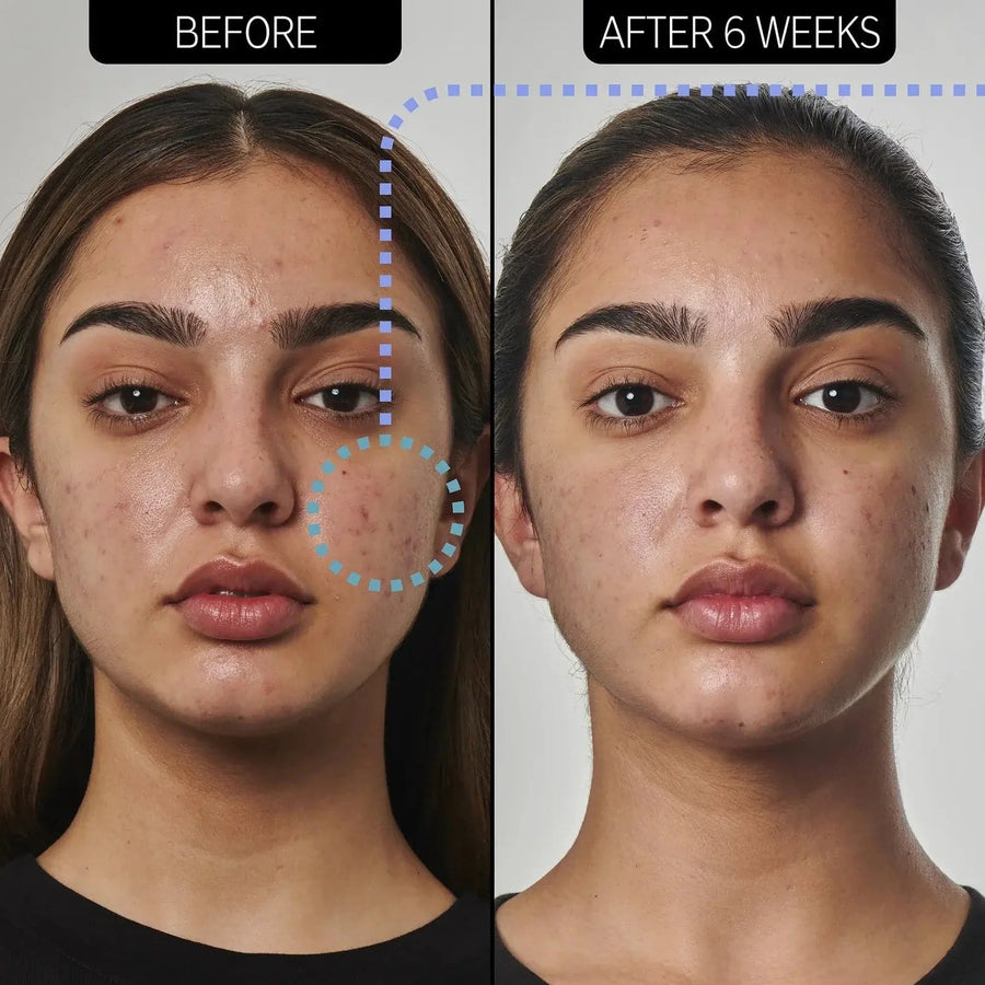 Acne Solution